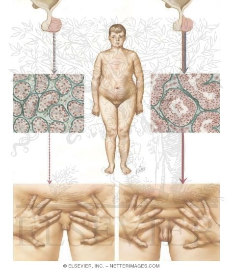 Testicular Failure V: Delayed Puberty