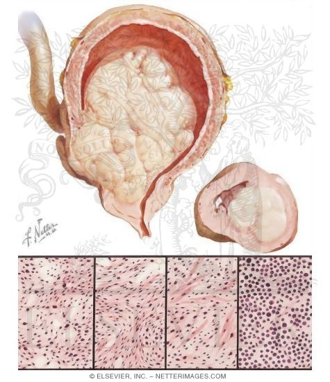 Watermarked preview of unlabeled image: Sarcoma of Prostate