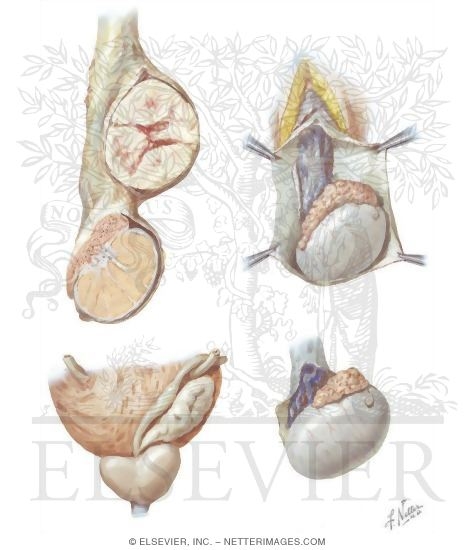 Anomalies of Seminal Tract - Tumors of Spermatic Cord