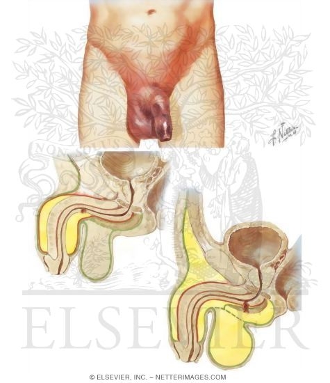 Urinary Extravasation