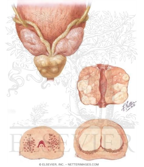 Watermarked preview of unlabeled image: Tuberculosis - Calculi