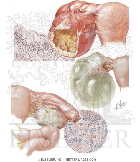 Watermarked preview of unlabeled image: Ovarian Infections