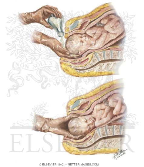 Watermarked preview of unlabeled image: Manual Rotation of the Transverse Diameter of the Pelvis