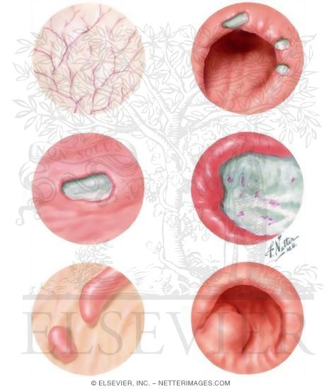 Watermarked preview of unlabeled image: Gastroscopic Diagnosis Of Malignant Disease