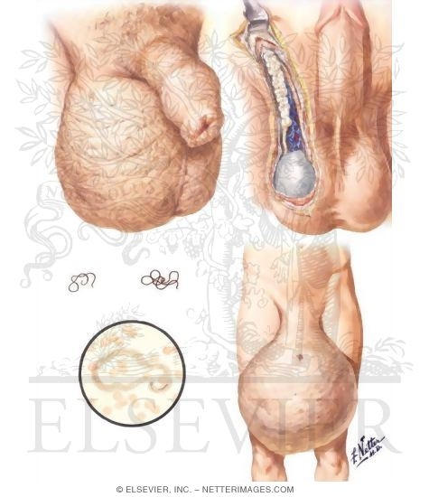 Elephantiasis of the Scrotum