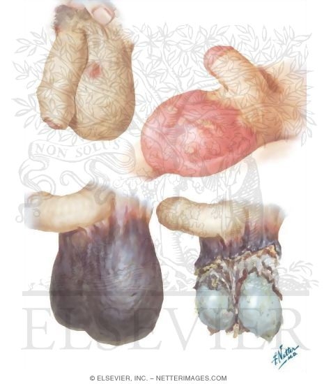 Watermarked preview of unlabeled image: Infection and Gangrene of the Testis
