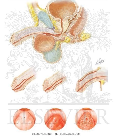 Diverticula of Urethra, Accessory Urethral Channels, Verumontanum Disorders