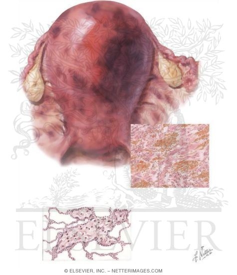 Couvelaire Uterus, Maternal Pulmonary Embolism