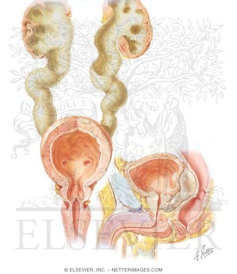 Watermarked preview of unlabeled image: Congenital Valve Formation, Congenital Cyst