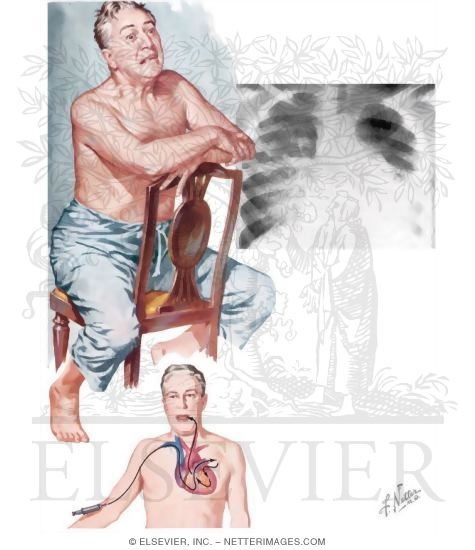 Left Heart Failure and Pulmonary Congestion
