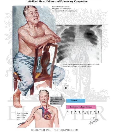Watermarked preview of labeled image: Left Heart Failure and Pulmonary Congestion