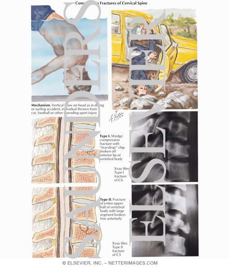 Watermarked preview of labeled image: Compression Fractures of Cervical Spine