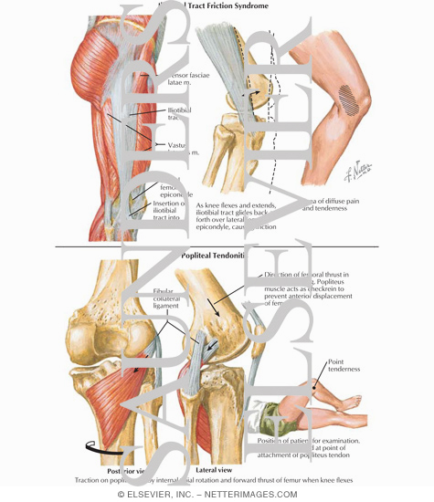 Watermarked preview of labeled image: Popliteus Tendinitis - lliotibial 