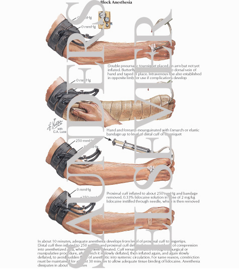 Bier Block Anesthesia
