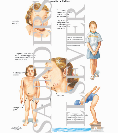 Watermarked preview of labeled image: Transplantation in Children
