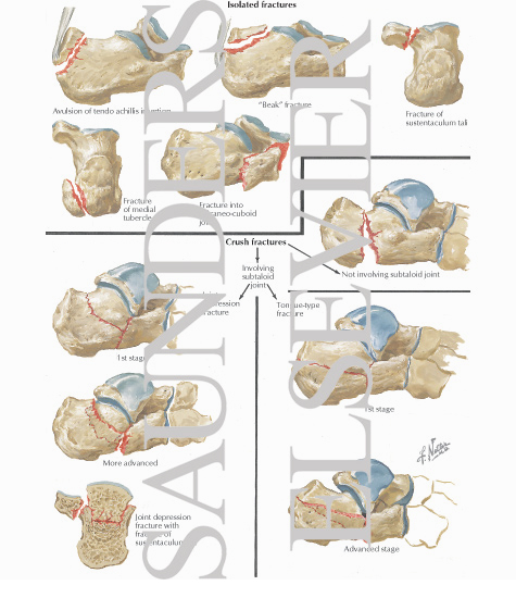 Watermarked preview of labeled image: Fractures of the Calcaneus