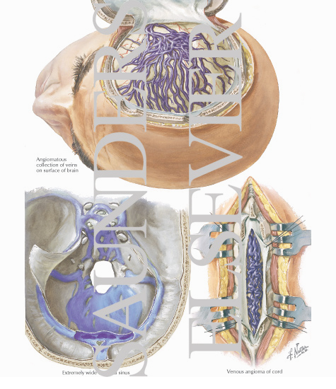 Watermarked preview of labeled image: Venous Anomalies