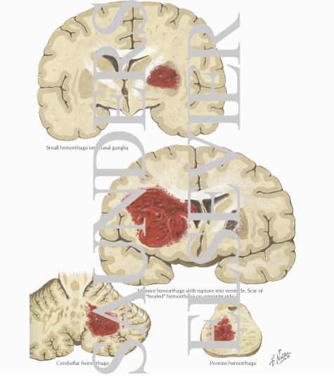 Watermarked preview of labeled image: Hypertensive Apoplexy