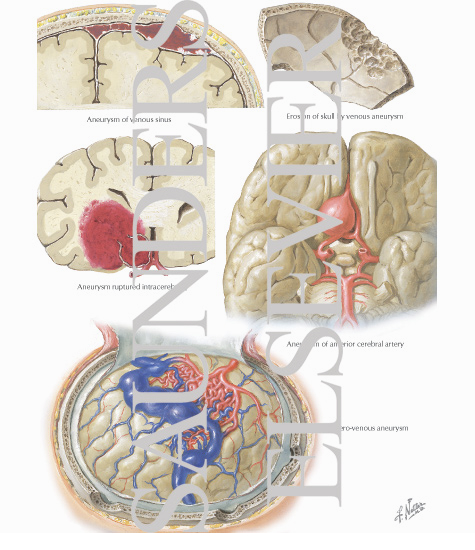 Intracranial Aneurysms