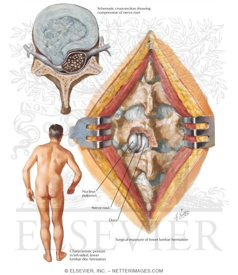 Watermarked preview of labeled image: Herniation of Lumbar Intervertebral Discs