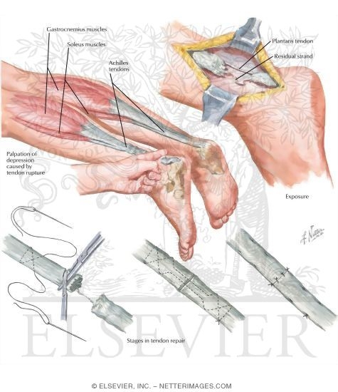 Watermarked preview of labeled image: Rupture of Achilles Tendon