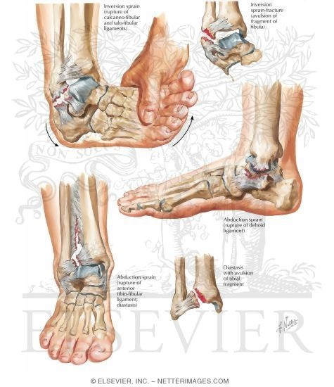 Watermarked preview of labeled image: Major Sprains and Sprain Fractures