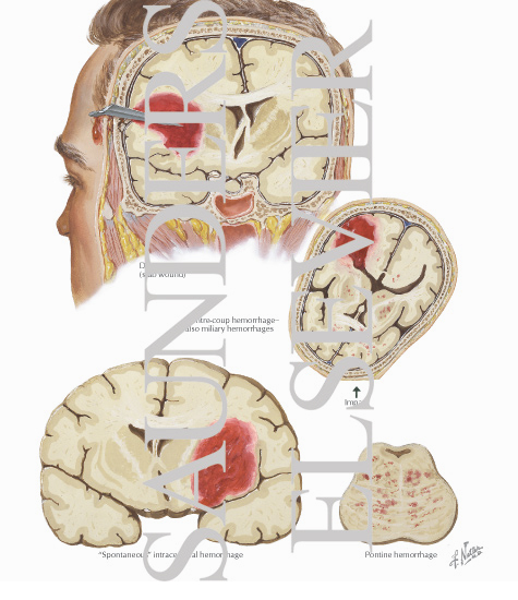 Intracerebral Hematoma