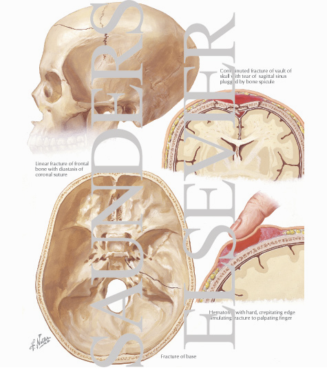 Fractures of the Skull