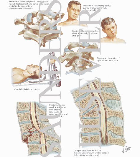 Watermarked preview of labeled image: Fractures and Dislocations of Spine