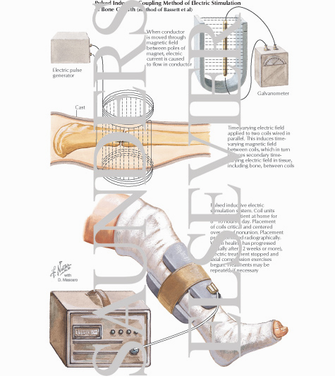 Watermarked preview of labeled image: Pulsed Inductive Coupling Method of Electric Stimulation of Bone Growth (method of Badssett et al)