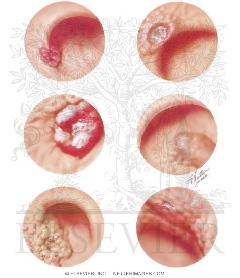 Watermarked preview of unlabeled image: Gastroscopic Diagnosis of Malignant Disease