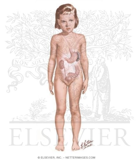 Watermarked preview of unlabeled image: Hemorrhagic Problems In Infants and Children