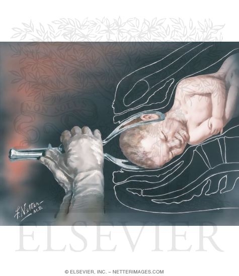 Watermarked preview of unlabeled image: The Use of Obstetric Forceps
