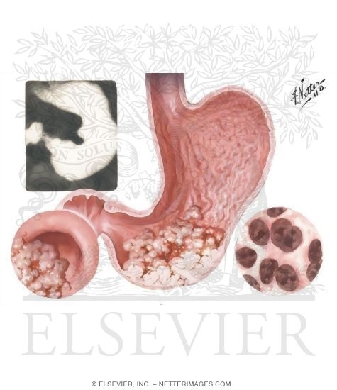 Watermarked preview of unlabeled image: Gastric Ulcer