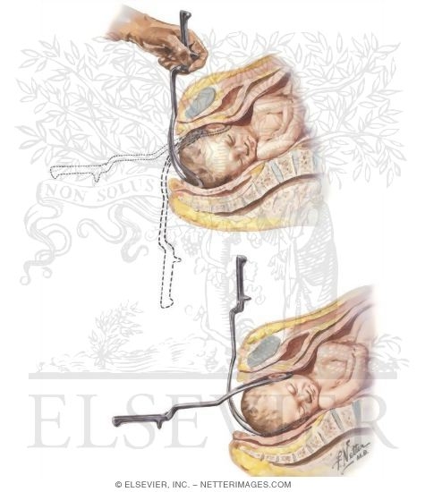 Watermarked preview of unlabeled image: Application of Forceps (Left and Right Blade)