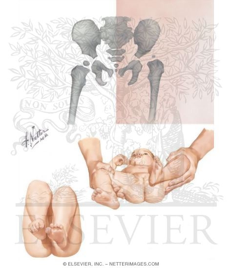 Watermarked preview of unlabeled image: Signs of Hip Dislocation
