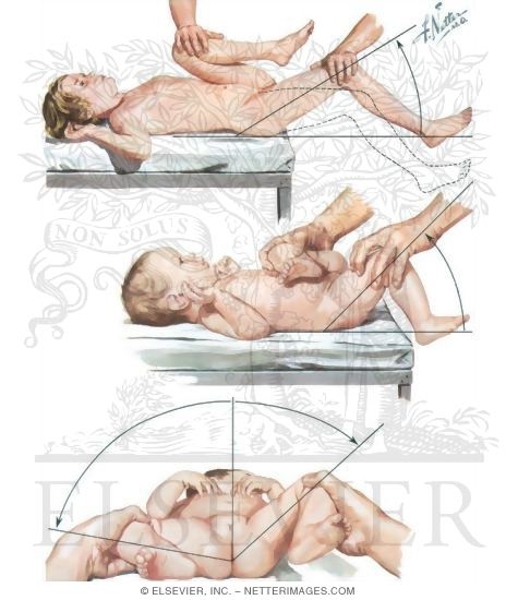 Watermarked preview of unlabeled image: Iliopsoatic Reinforced Tension Signs I