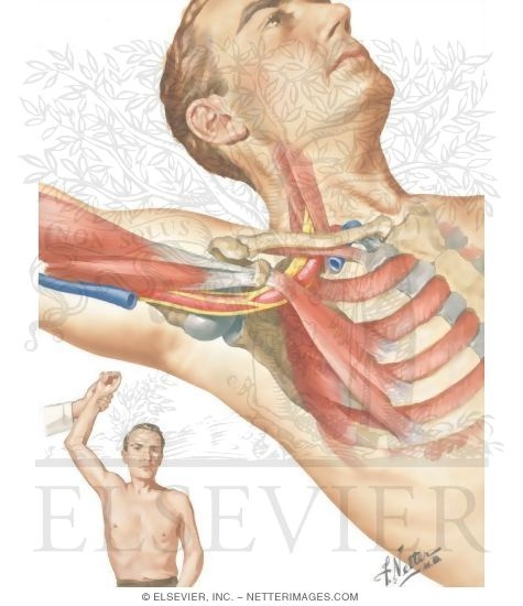 Pressure Exerted By Pectoralis Minor In Hyperabduction Syndrome