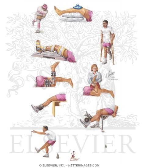 Watermarked preview of unlabeled image: Rehabilitation After Injury to Knee Ligaments