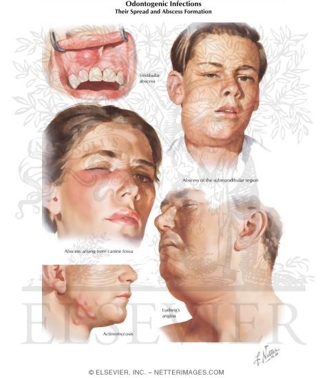 Odontogenic Infections - Their Spread and Abscess Formation