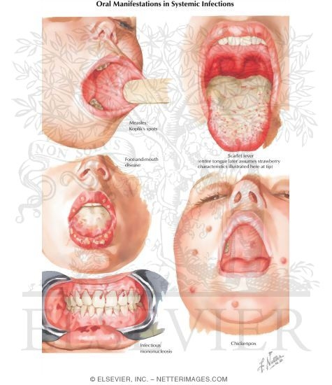 Watermarked preview of labeled image: Oral Manifestations in Systemic Infections
