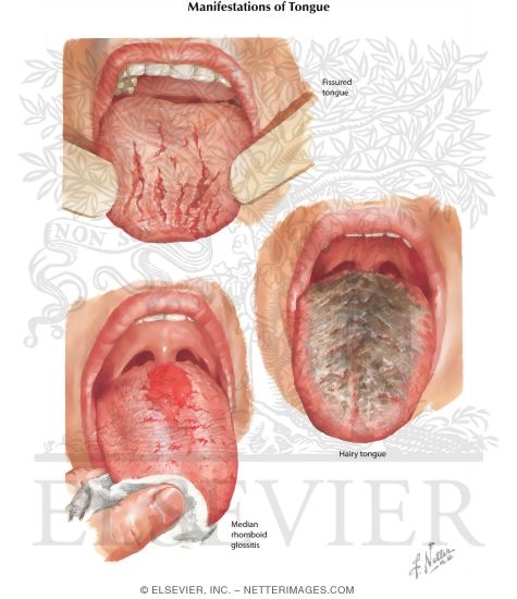 Watermarked preview of labeled image: Manifestations of Tongue