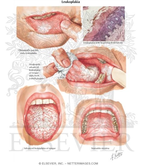 Leukoplakia