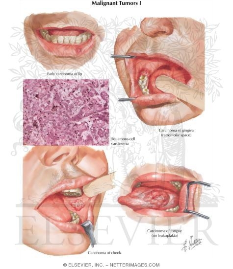 Watermarked preview of labeled image: Malignant Tumors I
