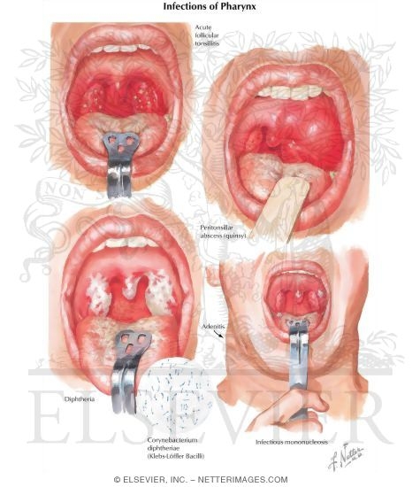 Infections of Pharynx