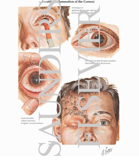 Watermarked preview of labeled image: Keratits (Inflammation of the Cornea)