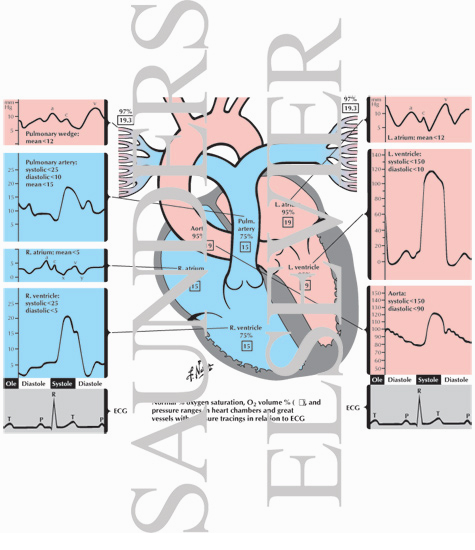 Cardiac Catheterization Normal Oxygen Pressure Normal