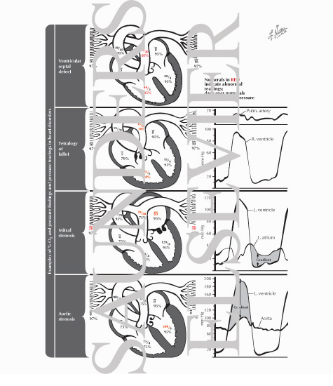 Watermarked preview of labeled image: Cardiac Catheterization - Abnormal Oxygen and Pressure Findings