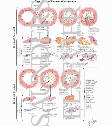 Hypothesis on Pathogenesis of Human Atherosclerosis