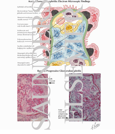 Watermarked preview of labeled image: Acute Glomerulonephritis